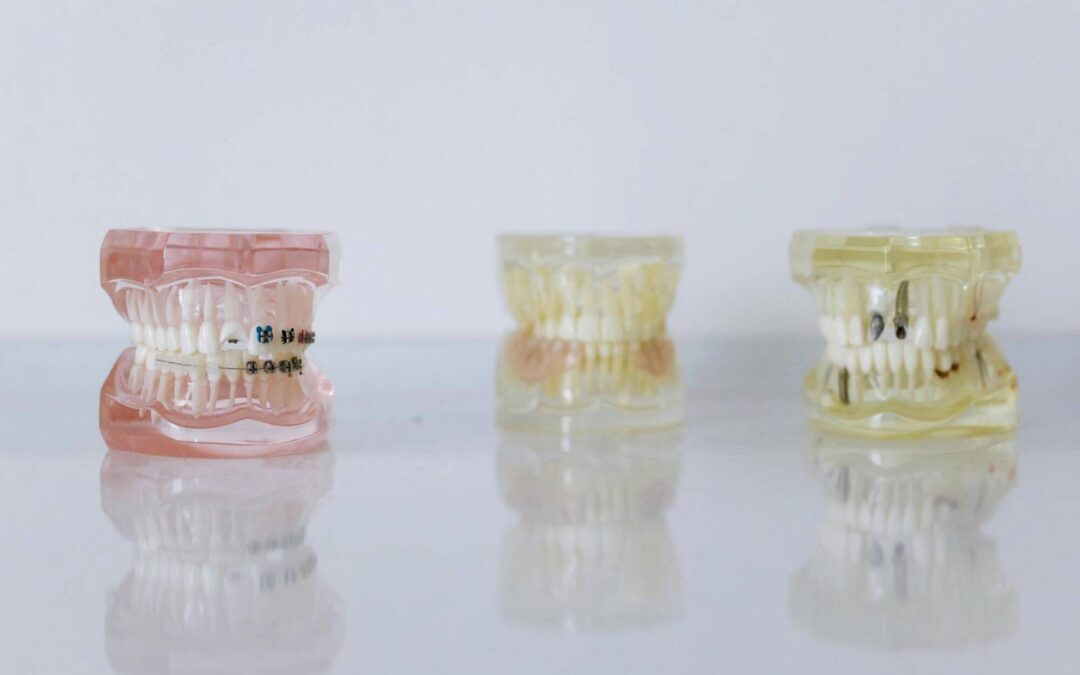 Implanty zębów – czym są, jak wyglądają i kiedy warto się na nie zdecydować?